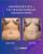 Abdominoplasty Breast Augumentaion With Fat Transfer - before (left) and after (right) result