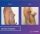 Breast Implants - before (left) and after (right) result