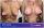 Breast Implants - before (left) and after (right) result