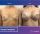 Breast Implants - before (left) and after (right) result