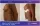 Abdominal And Flanks Liposution With Breast Fat Transfer - before (left) and after (right) result