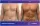 Abdominal Liposuction - before (left) and after (right) result