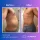 Abdominal and sides liposuction