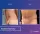 Abdominoplasty - before (left) and after (right) result
