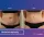 Abdominoplasty - before (left) and after (right) result