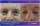 Blepharoplasty Eyebrow Lift - before (left) and after (right) result