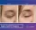 Blepharoplasty Upper Eyelids - before (left) and after (right) result