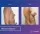 Breast Implants - before (left) and after (right) result