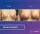 Breast Implants - before (left) and after (right) result