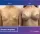 Breast Implants - before (left) and after (right) result