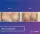 Breast Implants - before (left) and after (right) result