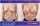 Breast Lift With Implants Areola Reconstruction 1 - before (left) and after (right) result
