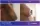 Breast Reduction - before (left) and after (right) result