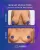 Breast Reduction - before (top) and after (bottom) result