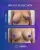 Breast Reduction - before (top) and after (bottom) result