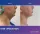 Chin Liposutction - before (left) and after (right) result