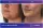 Face And Chin Liposuction - before (left) and after (right) result