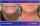 Face And Neck Lift - before (left) and after (right) result