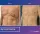 Ginecomasty - before (left) and after (right) result
