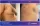 Ginecomasty - before (left) and after (right) result