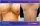 Ginecomasty - before (left) and after (right) result
