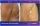 Ginecomasty With Liposuction - before (left) and after (right) result