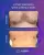 Ginecomasty With Liposuction - before (top) and after (bottom) result