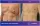 Ginecomasty With Liposuction - before (left) and after (right) result