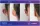 Otoplasty surgery
