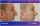 Rhinoplasty surgery