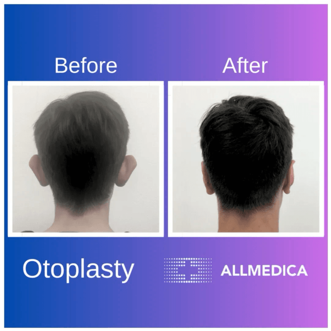 Otoplasty before after