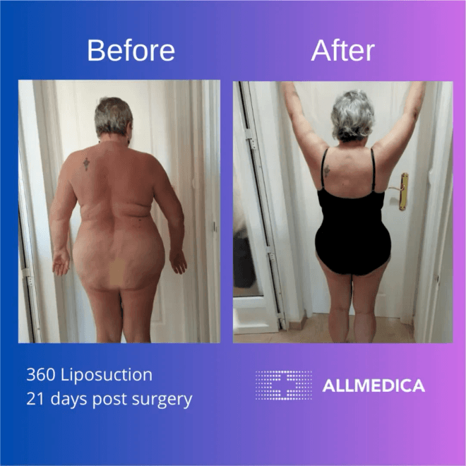 360 Liposuction before and after.