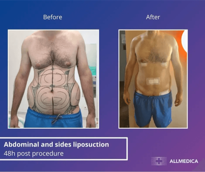 Abdominal And Sides Liposuction - before (left) and after (right) result
