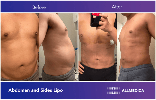 Abdominal And Sides Liposuction - before (left) and after (right) result