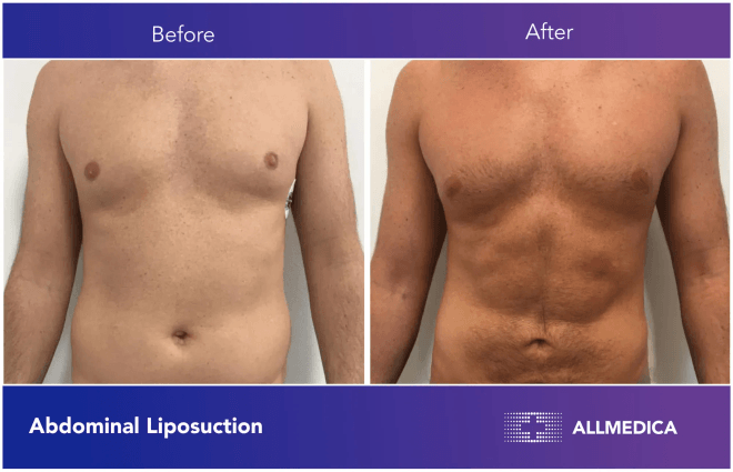 Abdominal Liposuction - before (left) and after (right) result