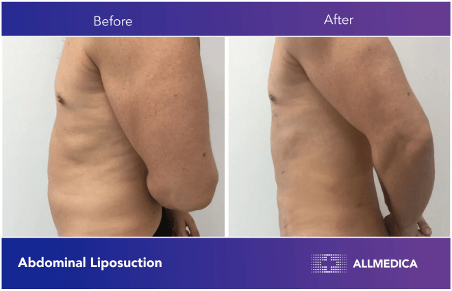 Abdominal Liposuction - before (left) and after (right) result