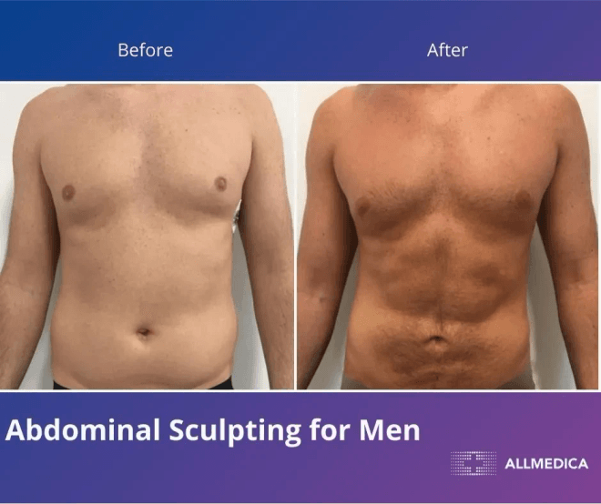 Abdominal Sculpting For Men - before (left) and after (right) result