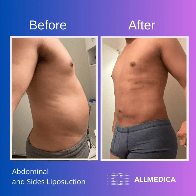 Abdominal and sides liposuction