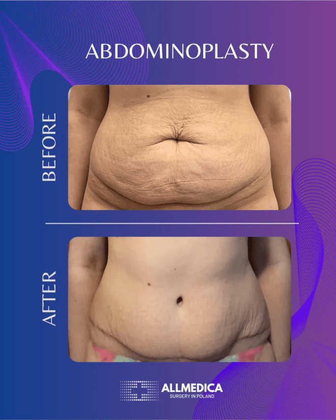 Abdominoplasty - before (top) and after (bottom) result