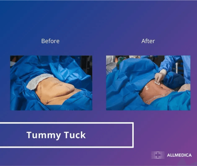 Abdominoplasty - before (left) and after (right) result