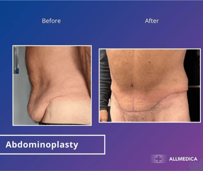 Abdominoplasty - before (left) and after (right) result