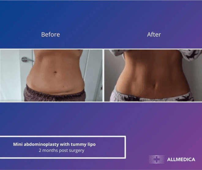 Abdominoplasty - before (left) and after (right) result