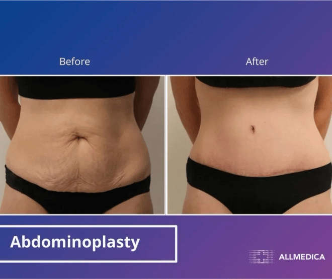 Abdominoplasty - before (left) and after (right) result