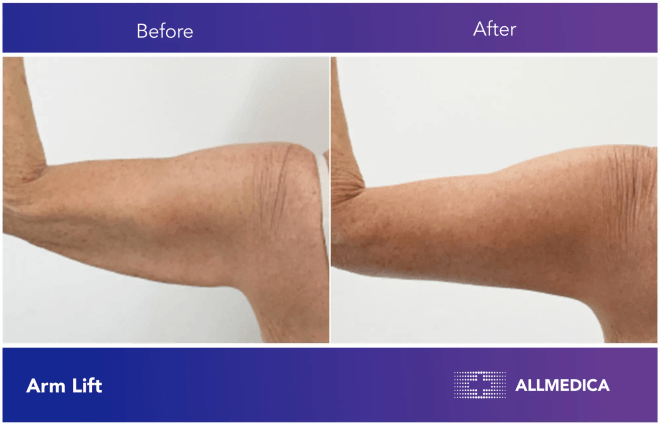 Arm Lift - before (left) and after (right) result