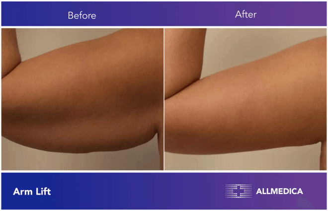Arm Lift - before (left) and after (right) result