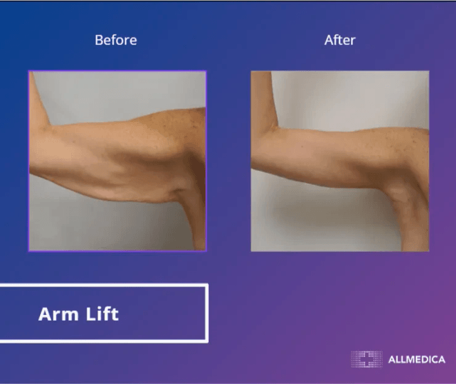Arm Lift - before (left) and after (right) result