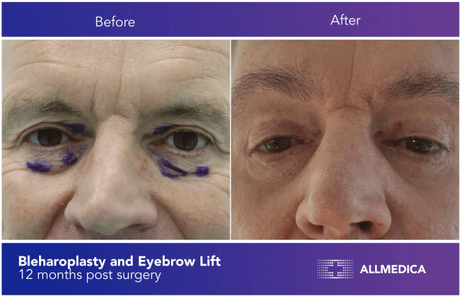 Blepharoplasty Eyebrow Lift - before (left) and after (right) result
