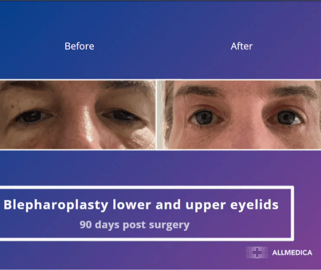 Blepharoplasty Lower And Upper Eyelids - before (left) and after (right) result