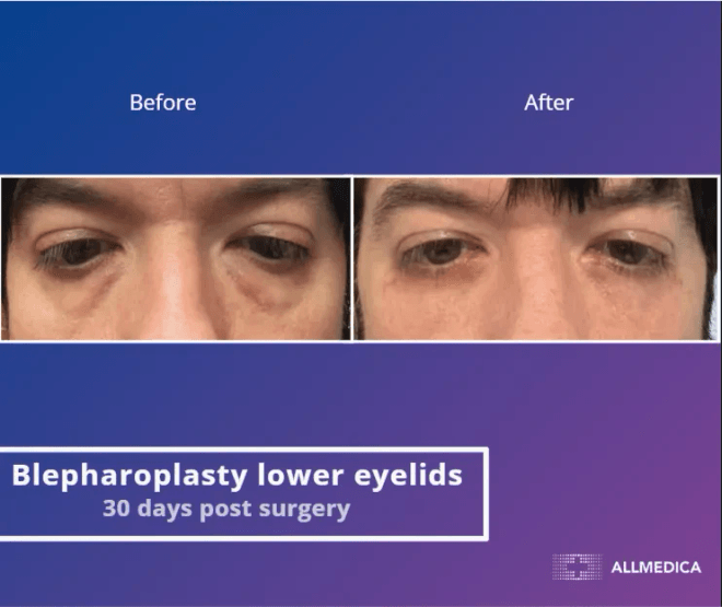 Blepharoplasty Lower Eyelids - before (left) and after (right) result