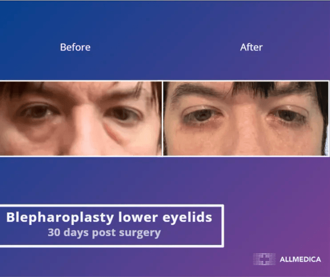 Blepharoplasty Lower Eyelids - before (left) and after (right) result